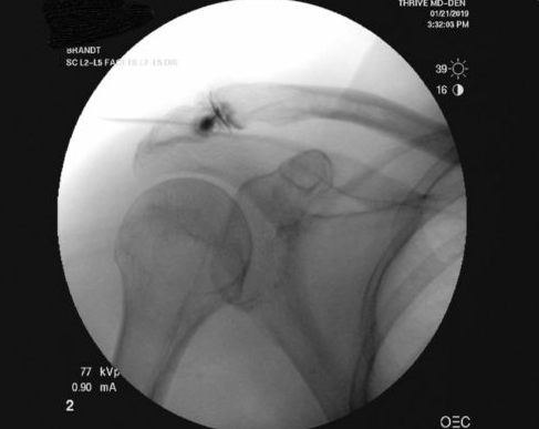 Placement of stem cells into an arthritic acromioclavicular joint of the shoulder under flouroscospic guidance (x-ray guided stem cell shoulder injection).