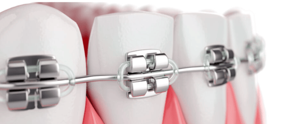 Images Diamond Braces Orthodontist: Braces & Invisalign