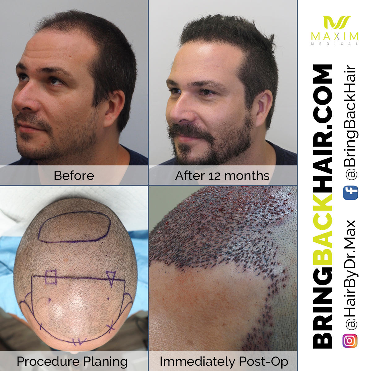 See the step by step process of Pedro’s hair restoration procedure using ARTAS Robotics. Make your dreams come true and achieve these similar outcomes with ARTAS robotic technology!