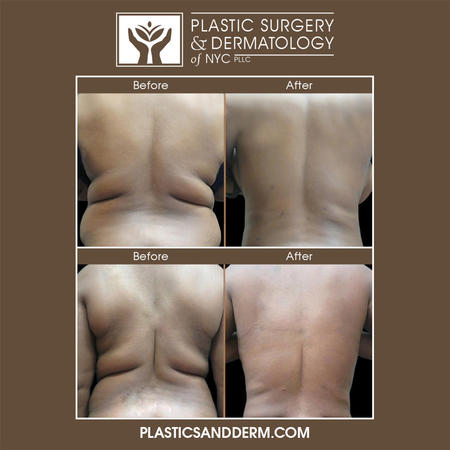 Liposuction can remove excess fat in the hips, abdomen, thighs, buttocks, arms, back, breasts, and knees. Combining traditional and laser liposuction techniques can reduce localized pockets of stubborn body fat while tightening the skin, so patients can expect improved body contours and a more sculpted figure.