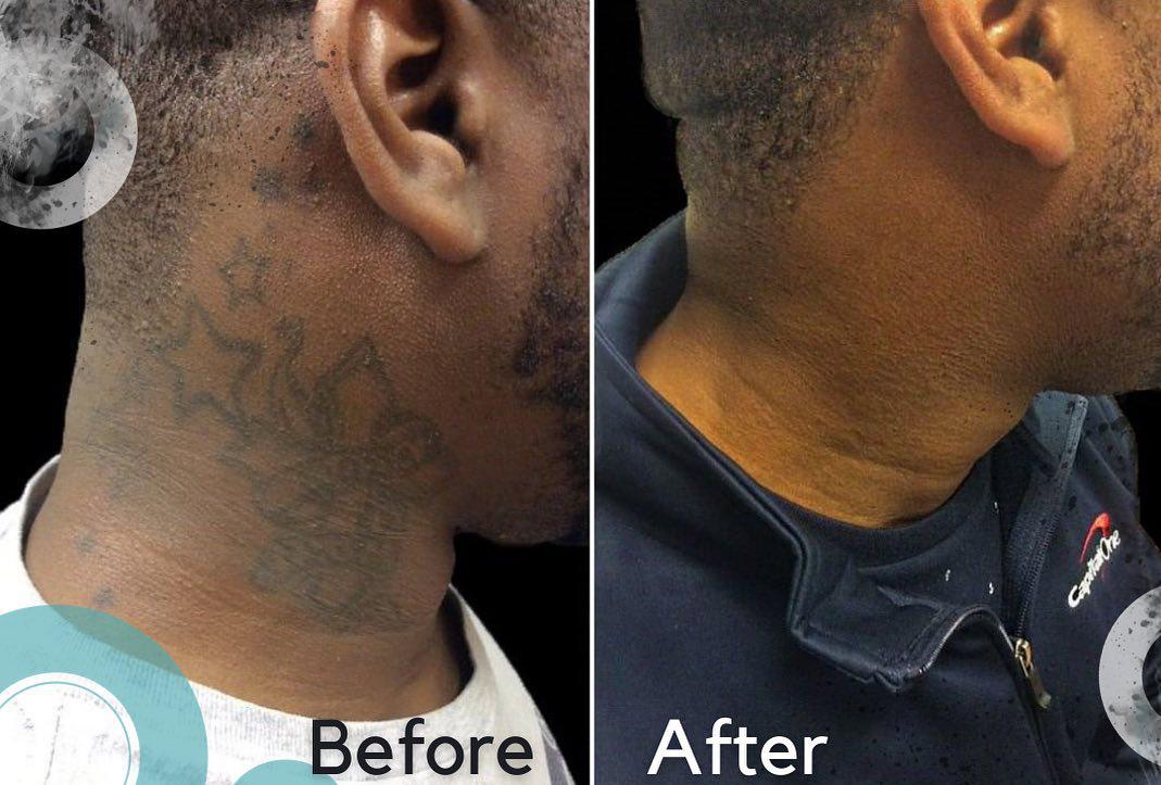 Removery Tattoo Removal & Fading in Ottawa: Before & After Neck Tattoo Removal
