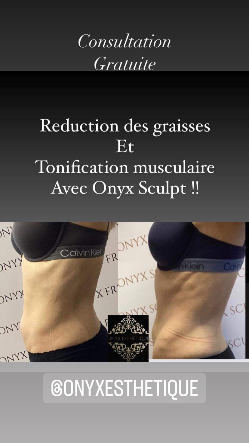 Images Onyx Esthétique - Soins esthétiques, Soins de la peau, Laser Cynosure Gatineau