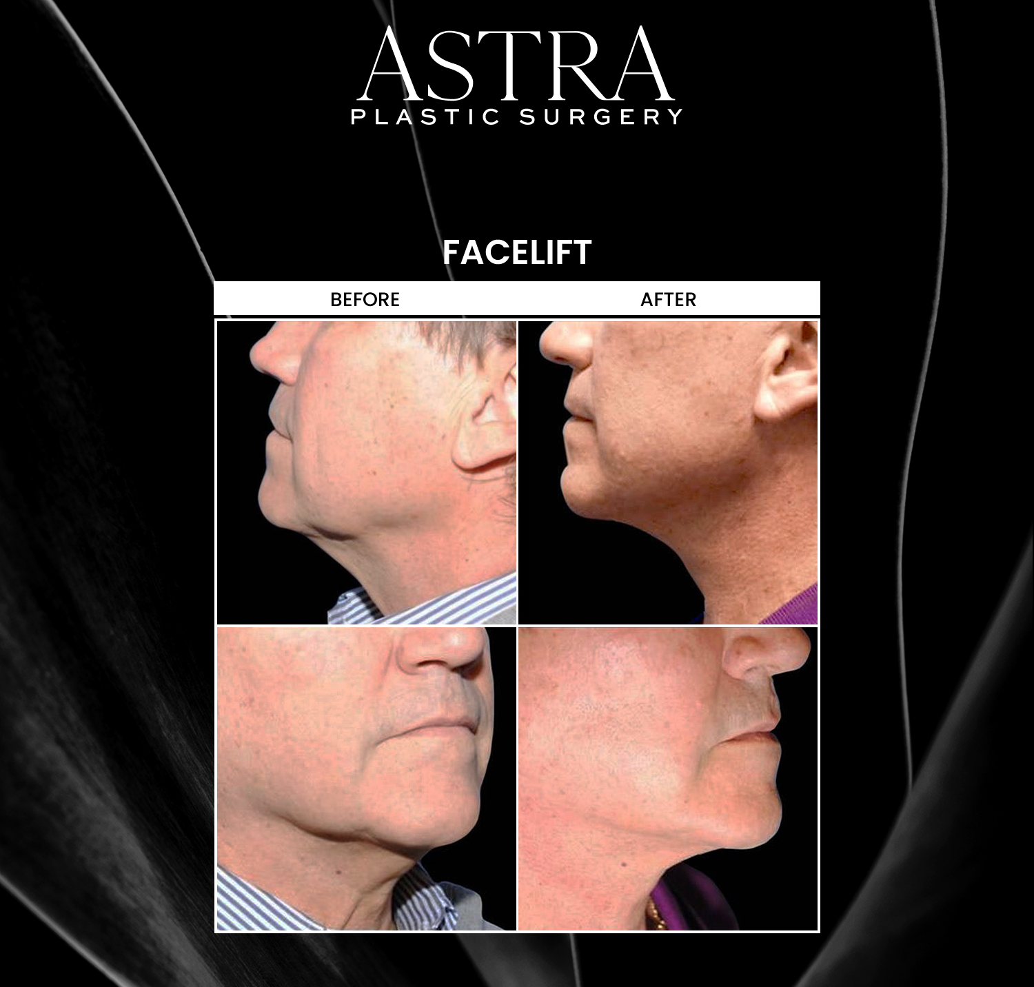 Facelift surgery can address the most common signs of aging. Fine lines, wrinkles, creases, and sagging skin can be prominent factors of aging. A facelift helps restore a natural, youthful appearance by tightening and lifting your facial tissue to enhance facial contours.