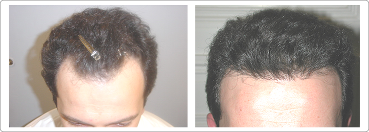 Images Hair Transplant Center NYC