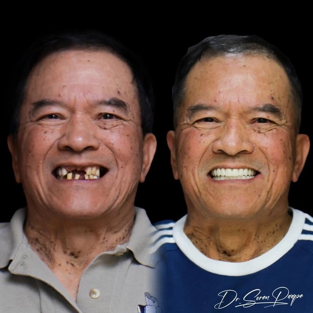 Images Smile Now Denver Dentures and Implants