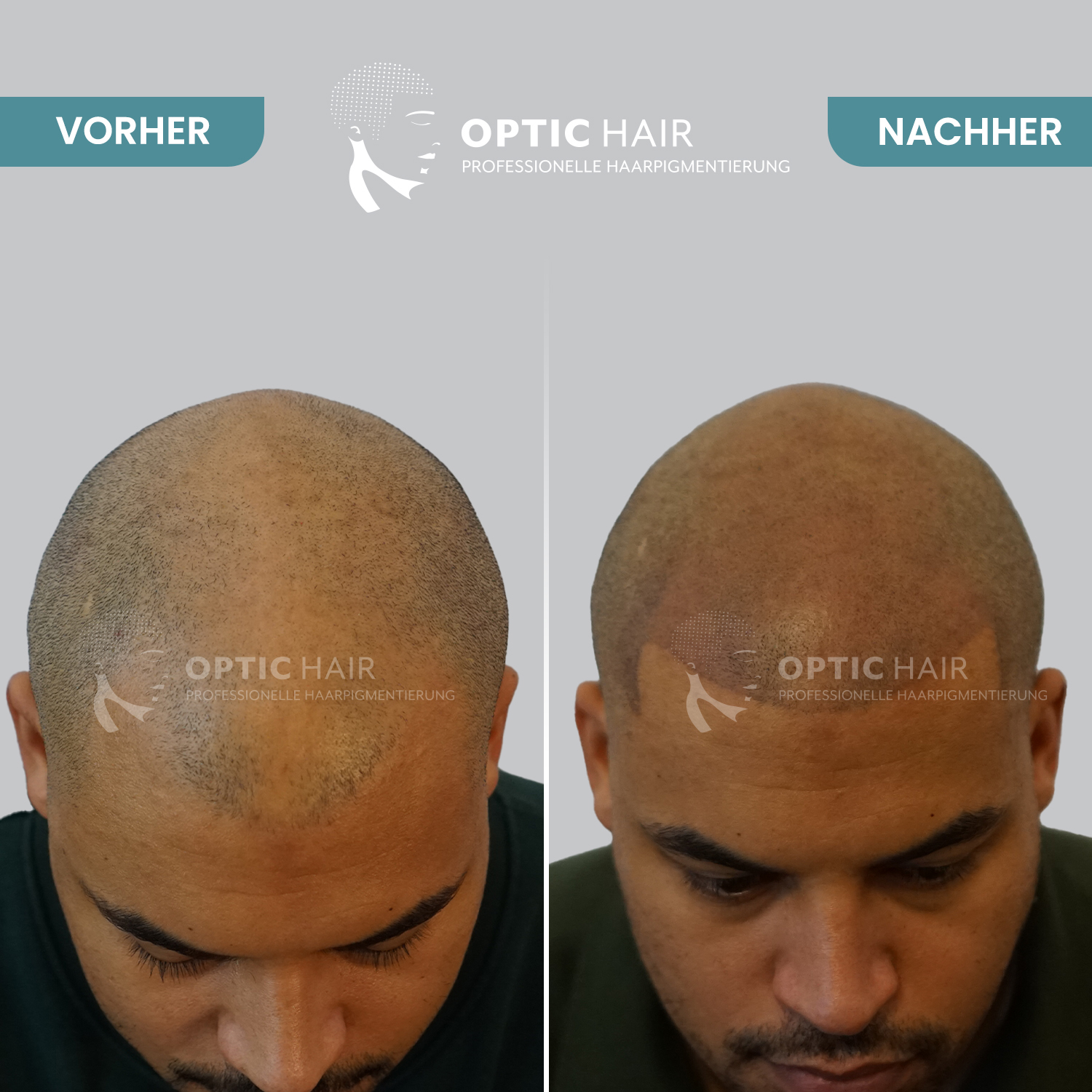 Kundenbild groß 13 Haarpigmentierung Köln | OpticHair