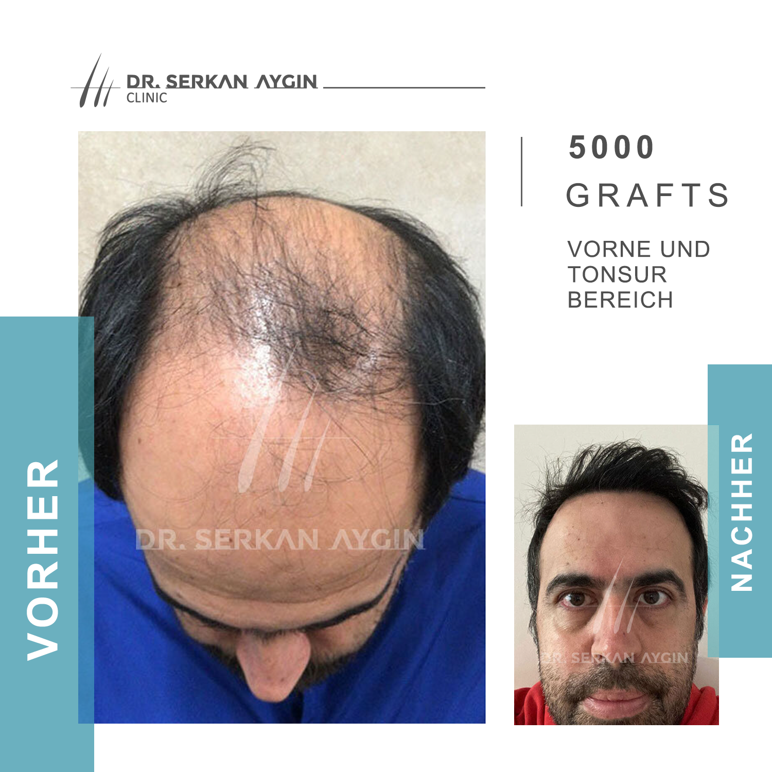 Kundenbild groß 17 Dr Serkan Aygin | Niederlassung Berlin | Haartransplantation Türkei