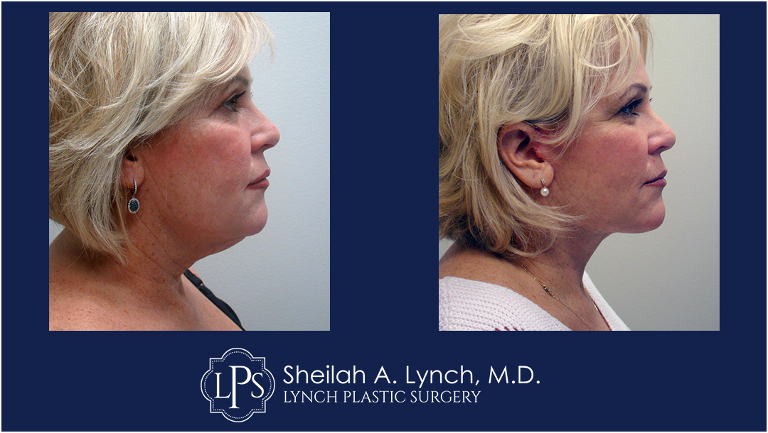 MACS Neck Lift Before & After Patient Chevy Chase Maryland. Plastic Surgeon Near Me Sheilah A. Lynch, MD