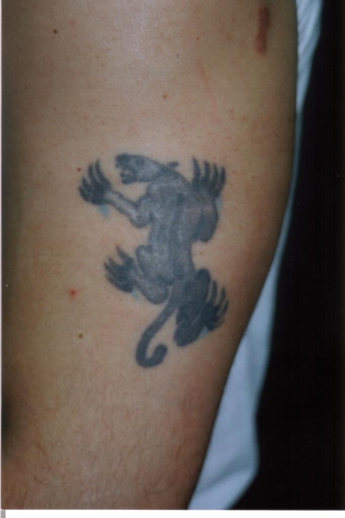 Winter Park Tattoo Removal Photo