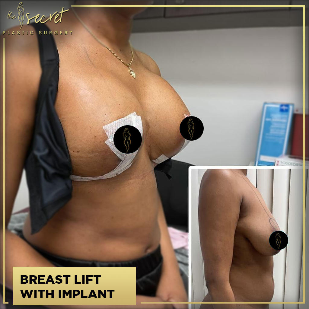 Breast Augmentation - The Secret Plastic Surgery