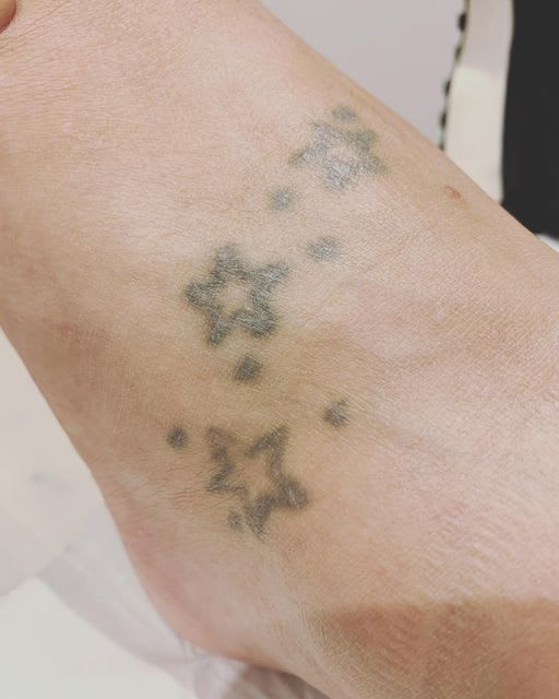Images NuSkin Tattoo Removal