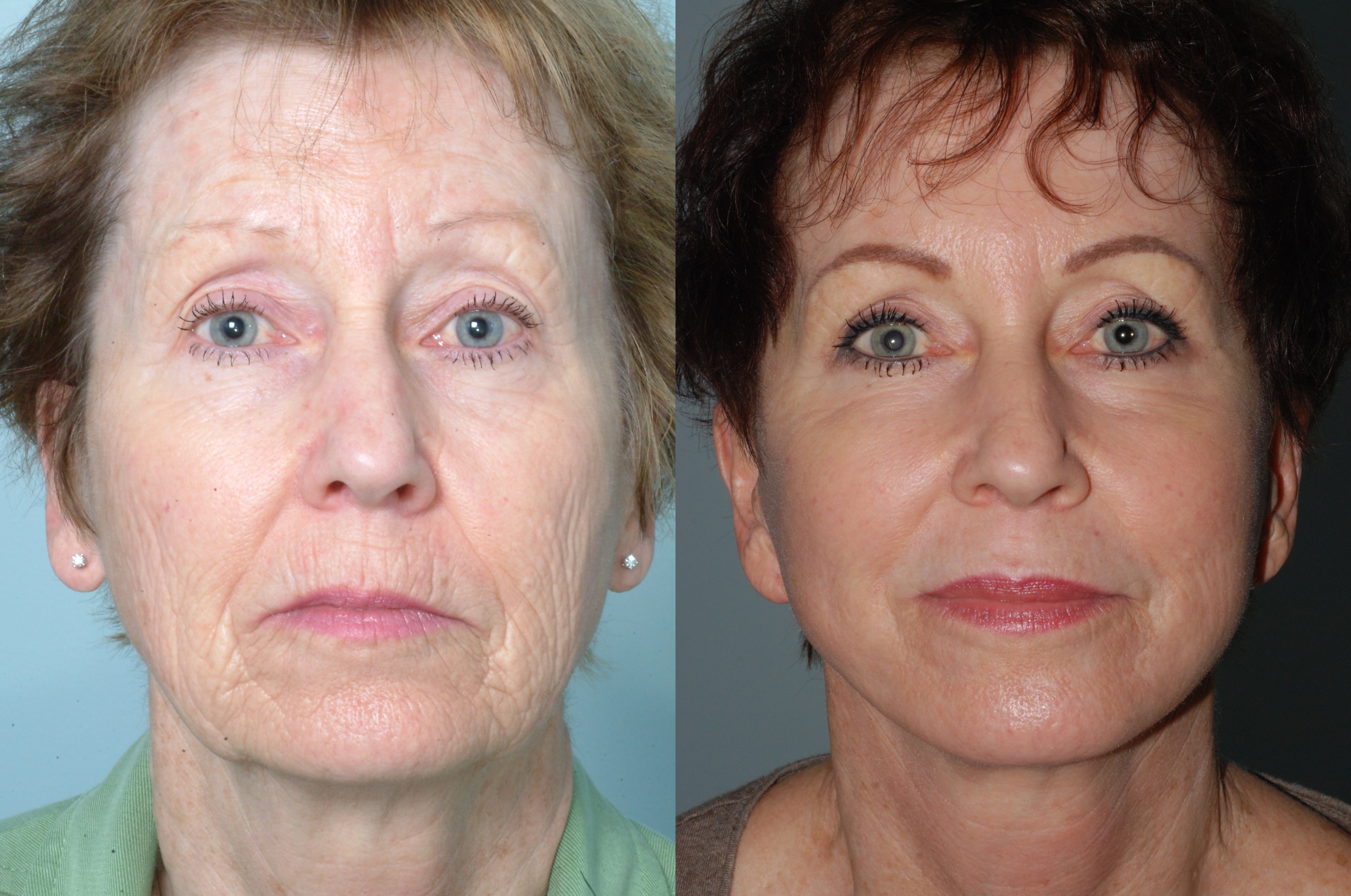 Facial rejuvenation with laser resurfacing,  fillers, Botox, upper eyelid blepharoplasty and  minimal incision face lift.