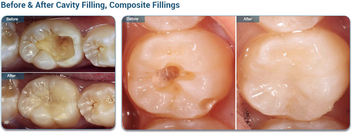 Before & After Cavity Filling, Composite Fillings