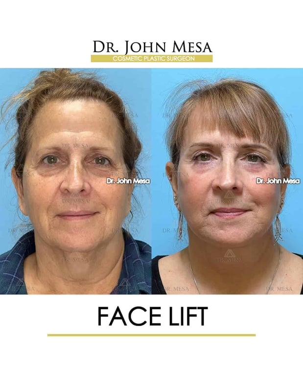 Images Dr. John Mesa, MD: Plastic Surgeon NYC, Buccal Fat Removal, Chin Liposuction, Facelift, Facial Masculinization, Chin Implant