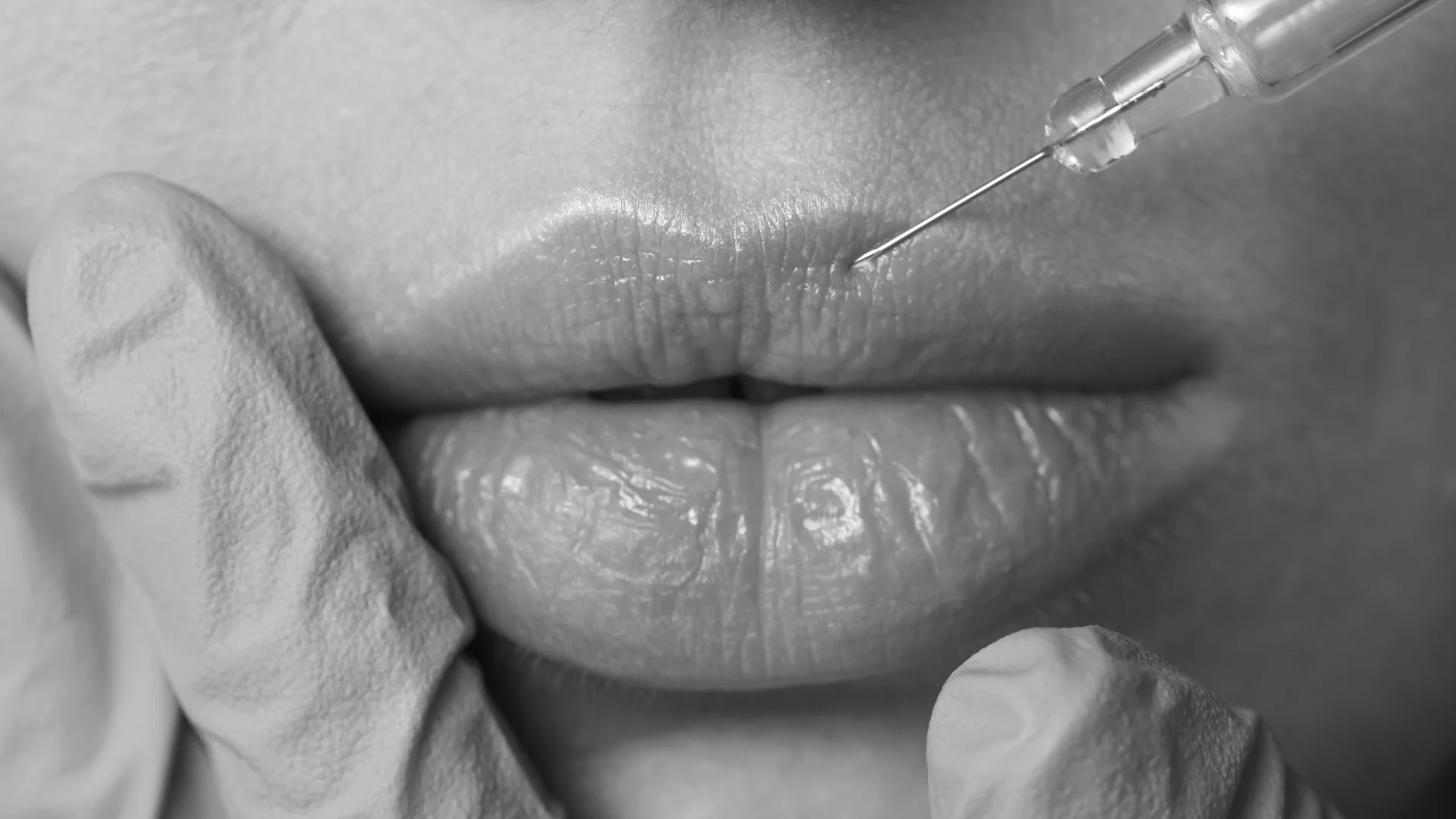 Close-up image of a cosmetic injection being administered near the upper lip.