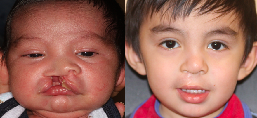 Right sided complete unilateral cleft lip before and approximately 1 year postop