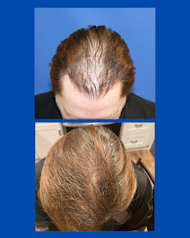 Images BKS Hair Restoration