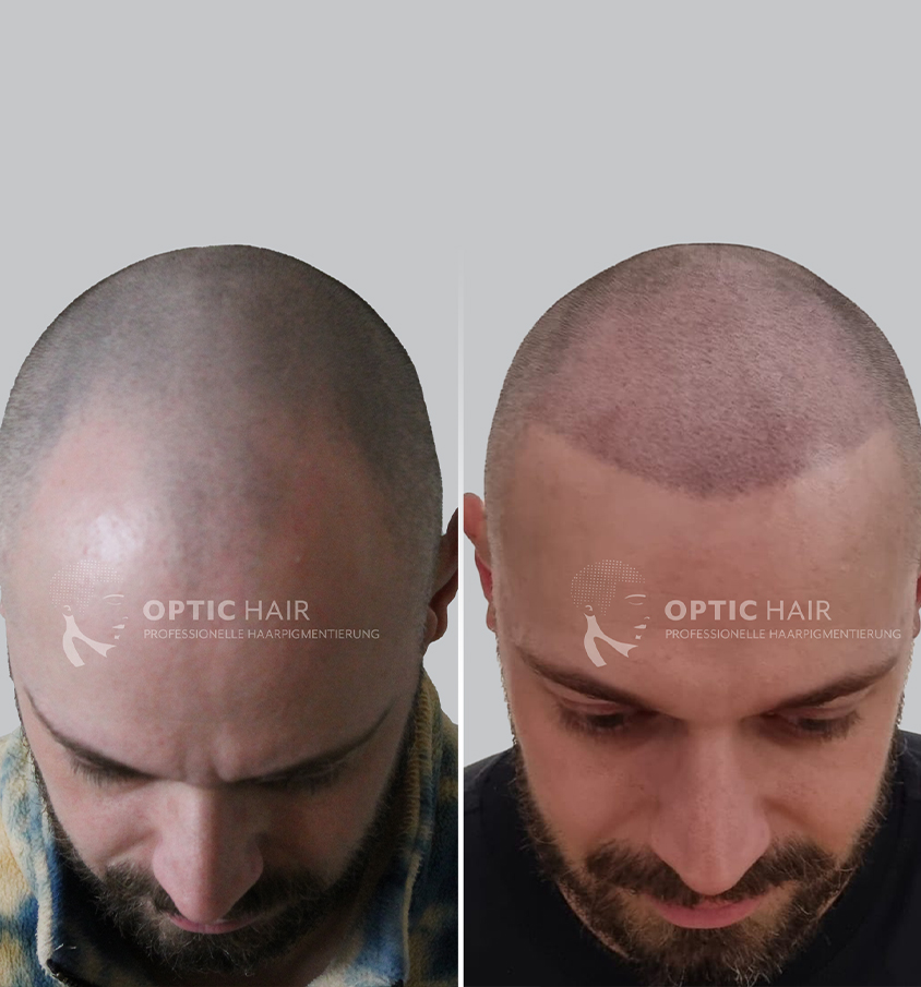 Kundenbild groß 26 Haarpigmentierung Köln | OpticHair