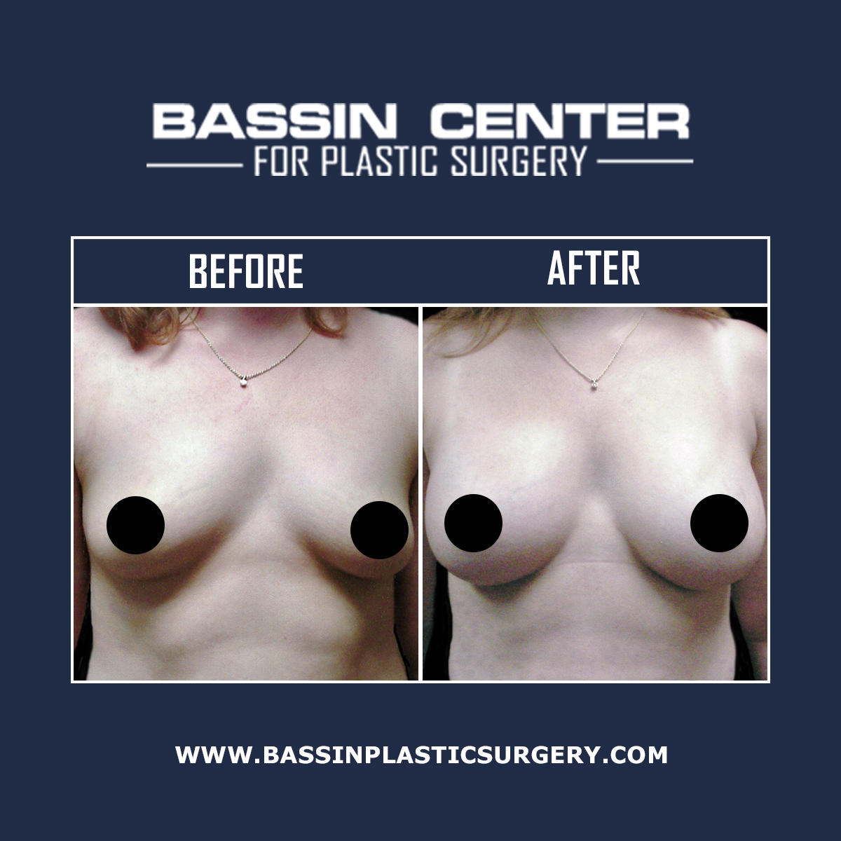 Breast enhancement can add lift, shape, and volume to the breasts. The Bassin Center for Plastic Surgery in Tampa creates a personalized treatment plan for each individual to achieve the most desirable results. We offer breast augmentation, breast lift, breast reduction, breast explant surgery, and more.