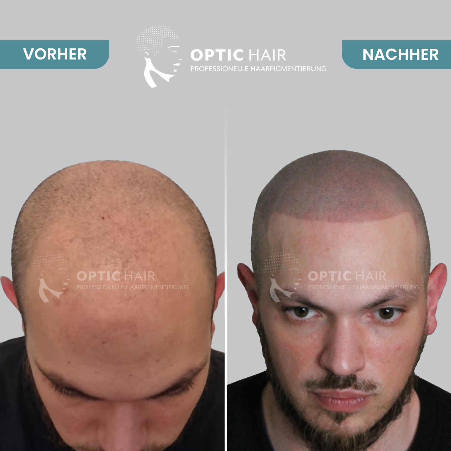 Haarpigmentierung Berlin | OpticHair, Silvio-Meier-Straße 2 in Berlin
