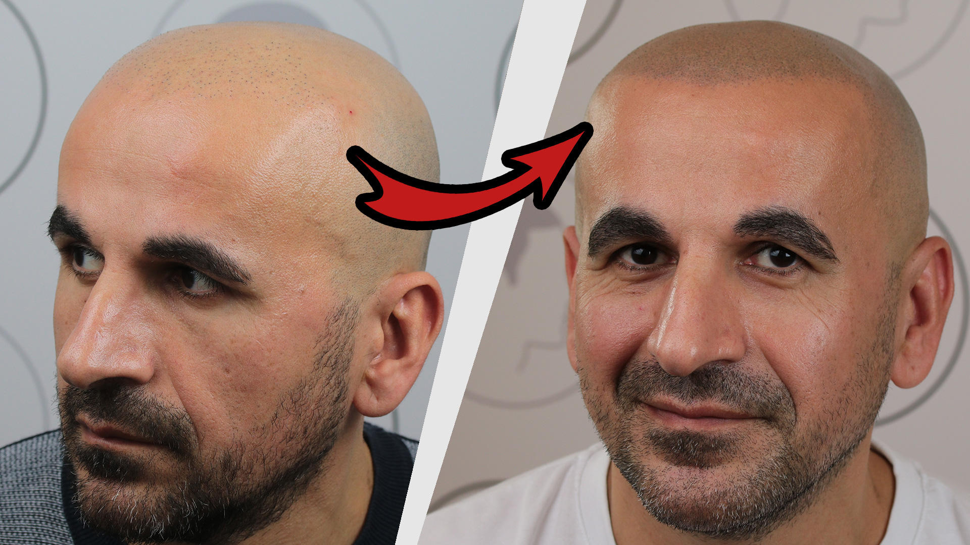 Bild 7 Haarpigmentierung | Modern Hair Loss Solution in Berlin