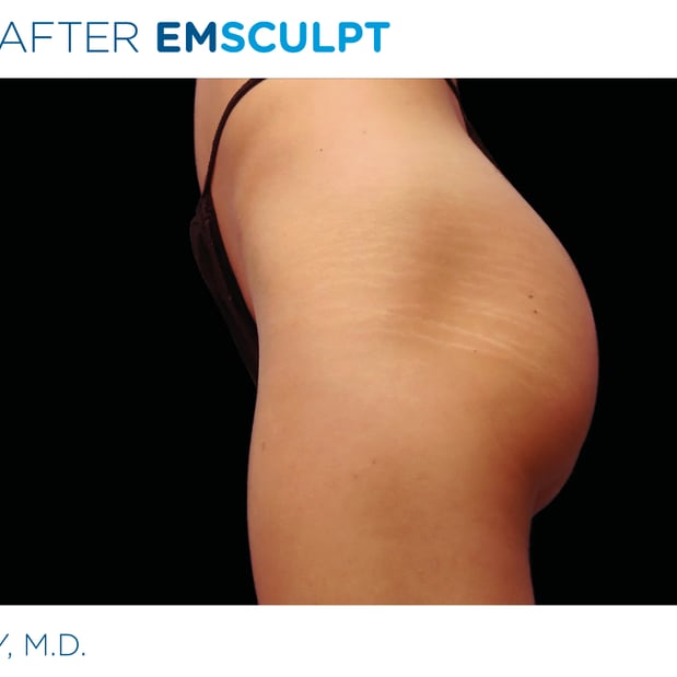 Images Columbus Emsculpt
