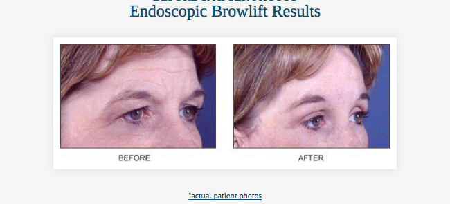 Endoscopic Before & After at Clinic of Facial Plastic Surgery | Buffalo, NY