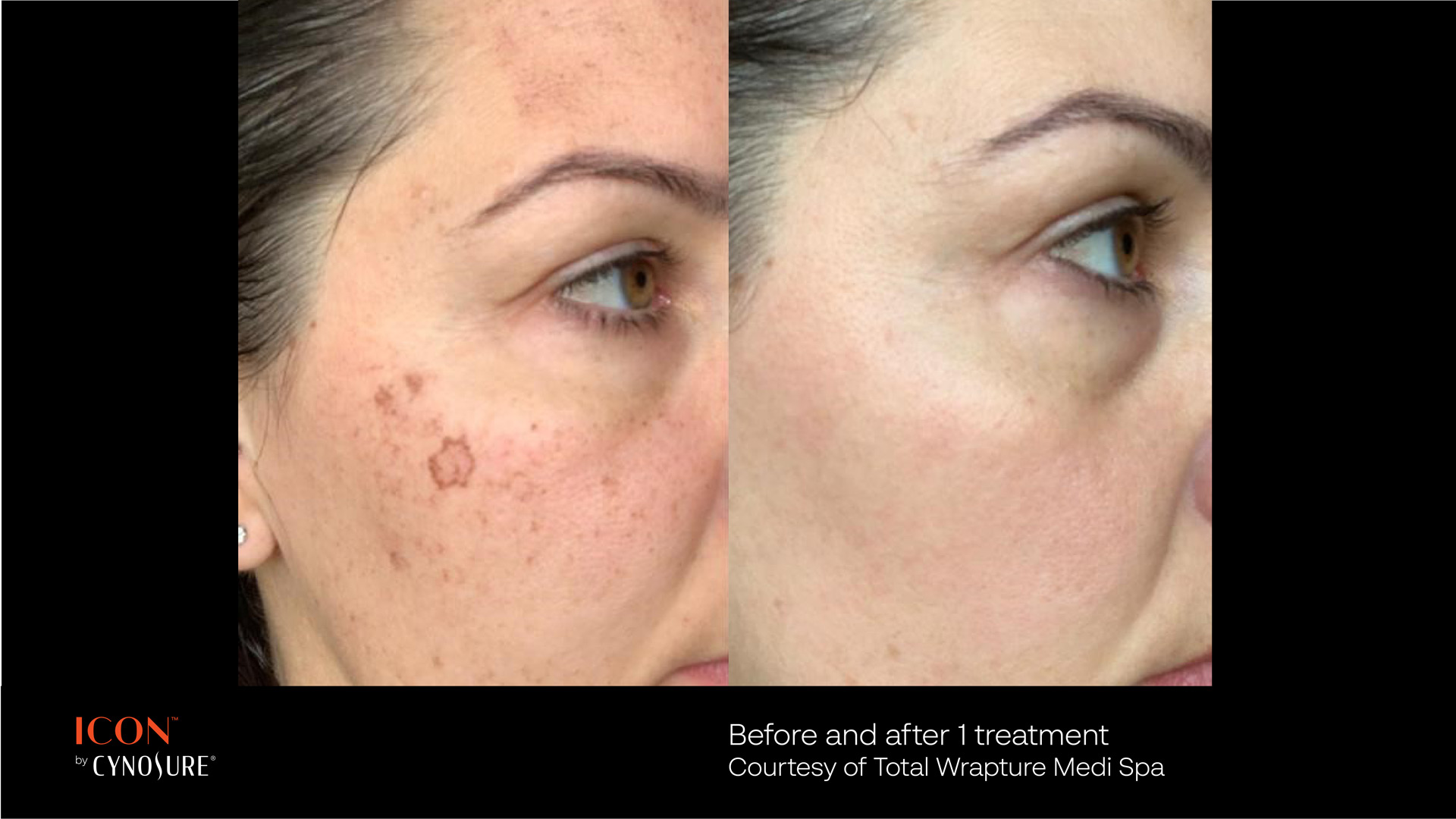 Images Onyx Esthétique - Soins esthétiques, Soins de la peau, Laser Cynosure Gatineau