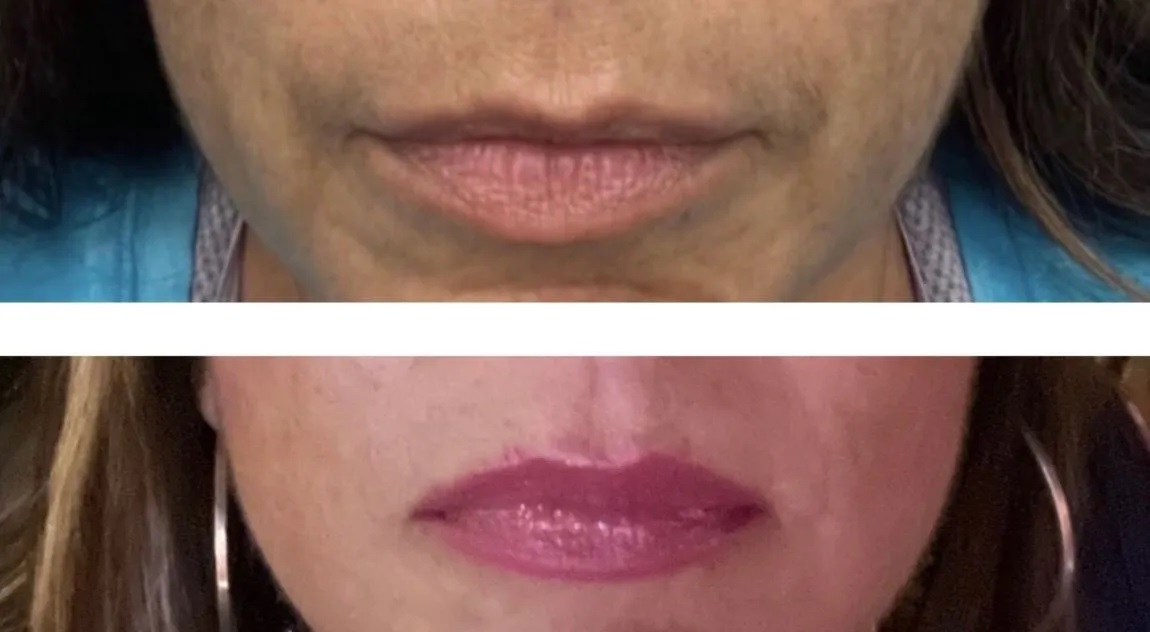 Botox Lip Flip Before & 3 Weeks After