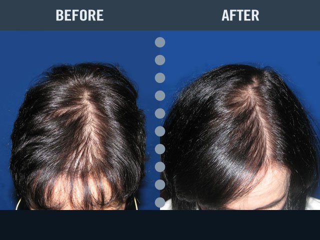 Images Hair Loss Control Clinic (HLCC) Latham