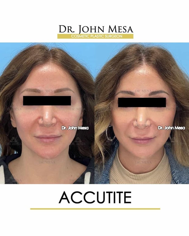 Images Dr. John Mesa, MD: Plastic Surgeon NYC, Buccal Fat Removal, Chin Liposuction, Facelift, Facial Masculinization, Chin Implant