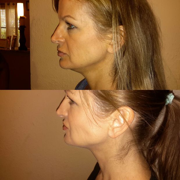 Kybella before and after
Kybella- is the only FDA-approved injectable treatment that destroys fat cells in the treatment area under the chin to improve your profile
Wymore Laser 407-622-2252