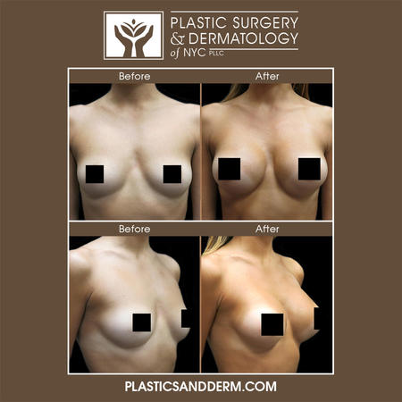 Breast enhancement surgery can increase breast size, restore lost shape and volume in the breasts, and correct issues with current breast implants. The variety of breast enhancement surgery options available at Plastic Surgery & Dermatology of NYC PLLC ensure patients will be able to find the ideal solution for their personal body goals.