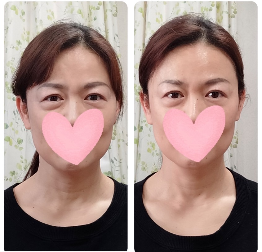 Images 目元・口元のたるみ&眉間シワ改善専門サロン