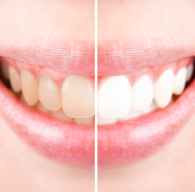 The Approach of Warren, MI's Sparkle Dental to Teeth Whitening will have you Smiling