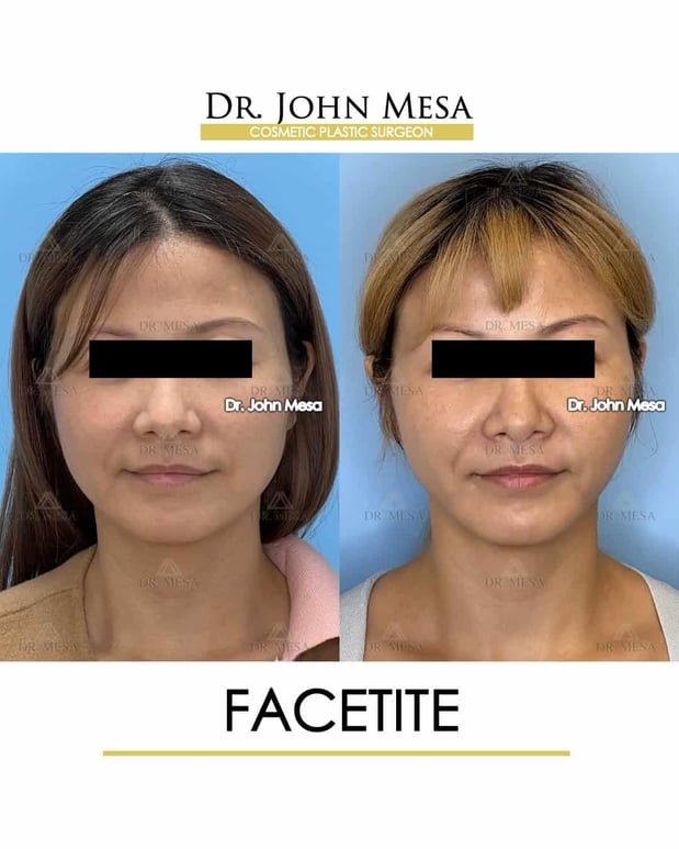 Images Dr. John Mesa, MD: Plastic Surgeon NYC, Buccal Fat Removal, Chin Liposuction, Facelift, Facial Masculinization, Chin Implant