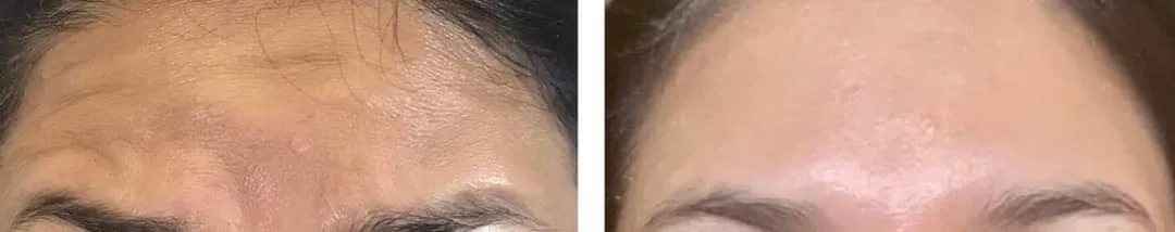 Forehead Botox Before & 3 Weeks After