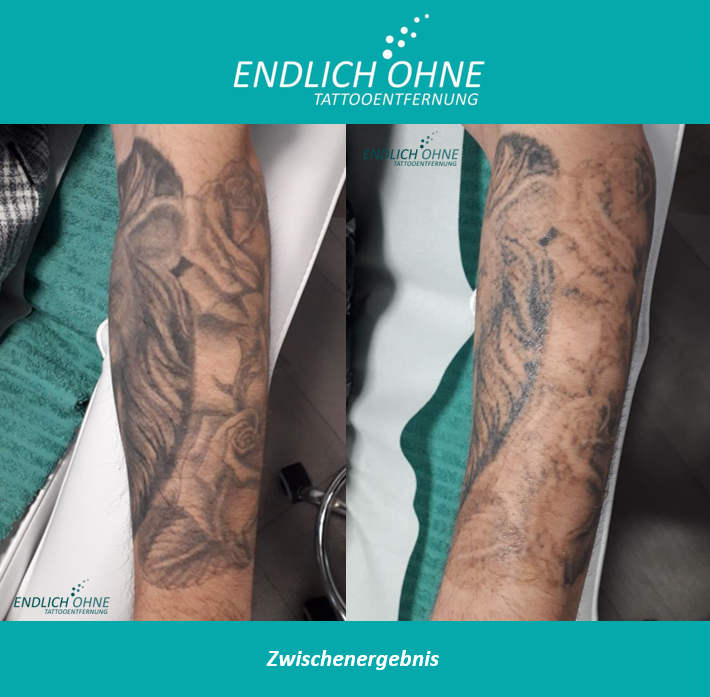 Bilder ENDLICH OHNE Tattooentfernung / Permanent Make-up Entfernung Stuttgart