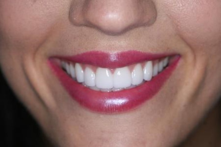 Elite Dental American Fork | Dentist & Implants American Fork (801)477-6544