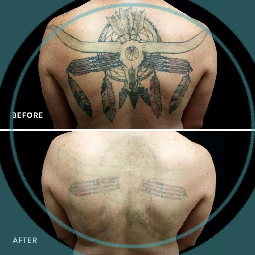 Removery Tattoo Removal & Fading à Ottawa: Before & After Back Tattoo Removal