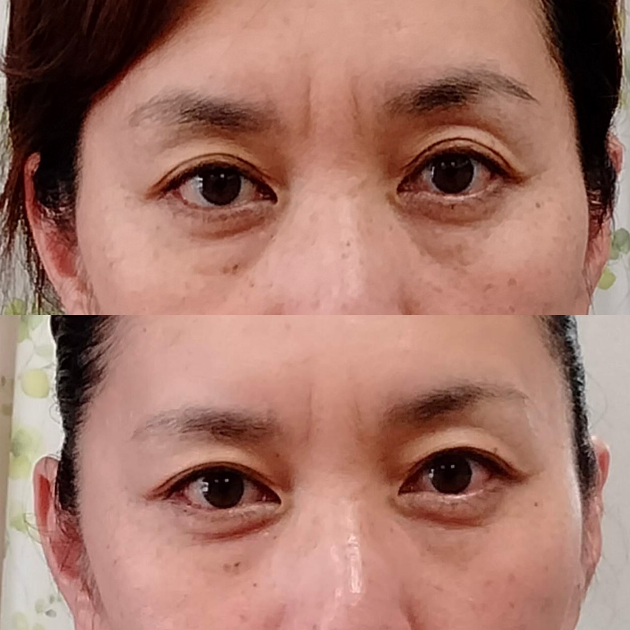 Images 目元・口元のたるみ&眉間シワ改善専門サロン