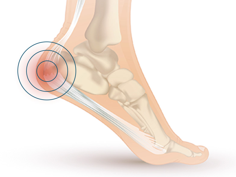 footpain-heel.png