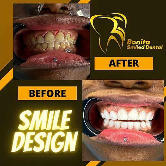 Bonita Smiled Dental - smile design