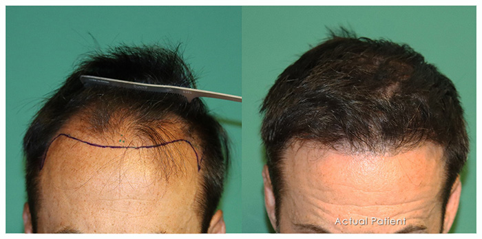 Images BKS Hair Restoration