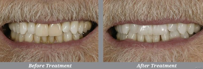 Teeth Whitening Before & After, Joseph P. Fusco DDS, MAGD | Rockville Centre, NY
