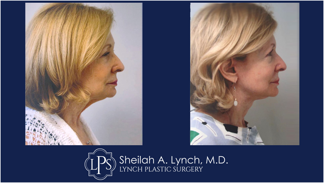 Neck Lift Before & After Patient Chevy Chase Maryland. Plastic Surgeon Near Me Sheilah A. Lynch, MD