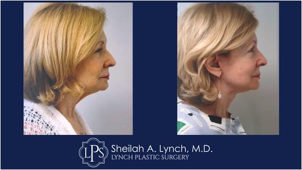 Images Sheilah A. Lynch, MD - Lynch Plastic Surgery