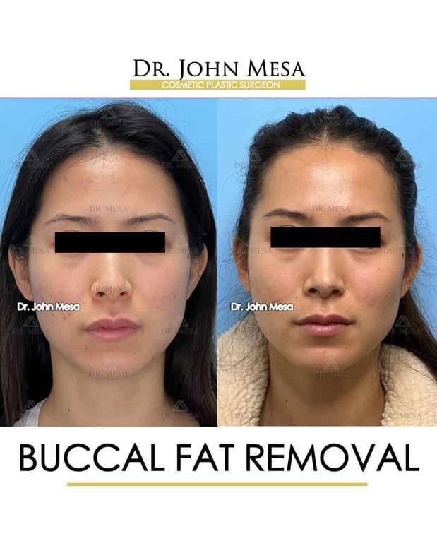 Images Dr. John Mesa, MD: Plastic Surgeon NYC, Buccal Fat Removal, Chin Liposuction, Facelift, Facial Masculinization, Chin Implant