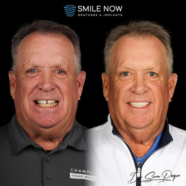 Images Smile Now Denver Dentures and Implants