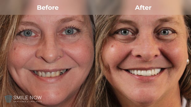 Images Smile Now Tacoma Dentures and Implants